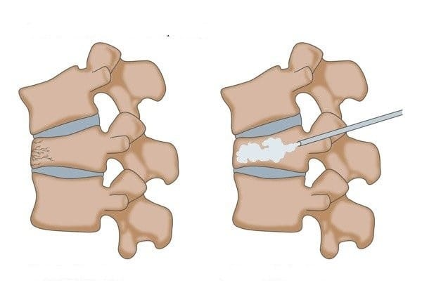 vertebroplasty in Delhi