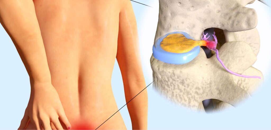 Top Spine Surgeon in Delhi NCR